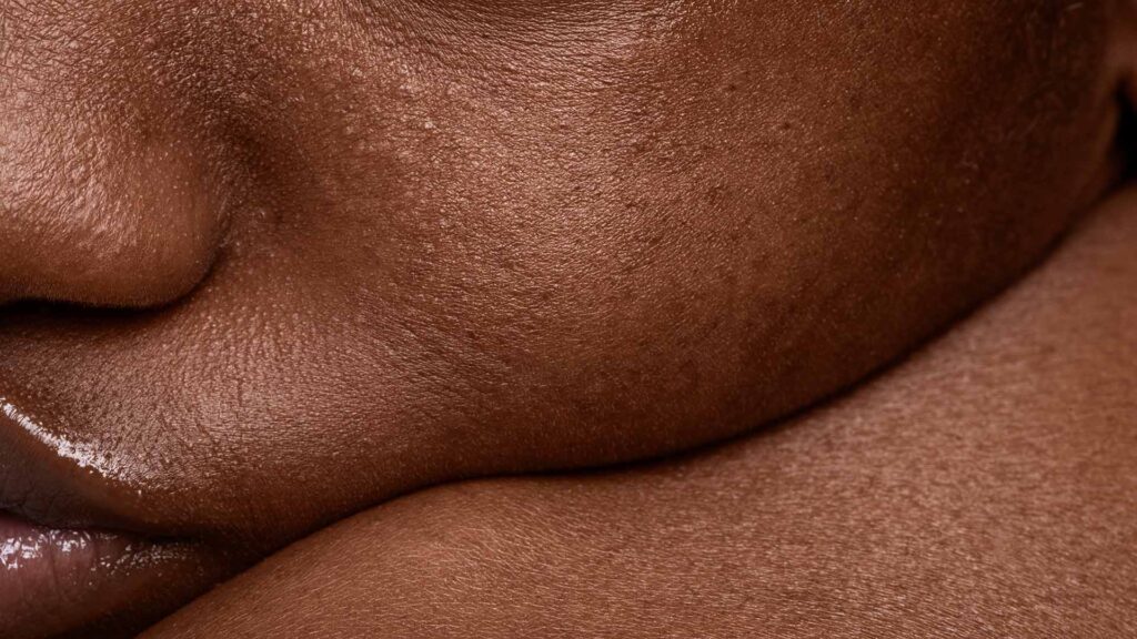 What To Do When Body Acne Strikes + The Best Products To Use